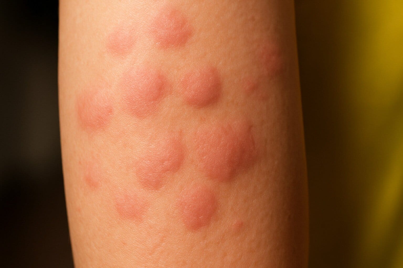Hives: Complete Guide to Causes, Triggers & Cure