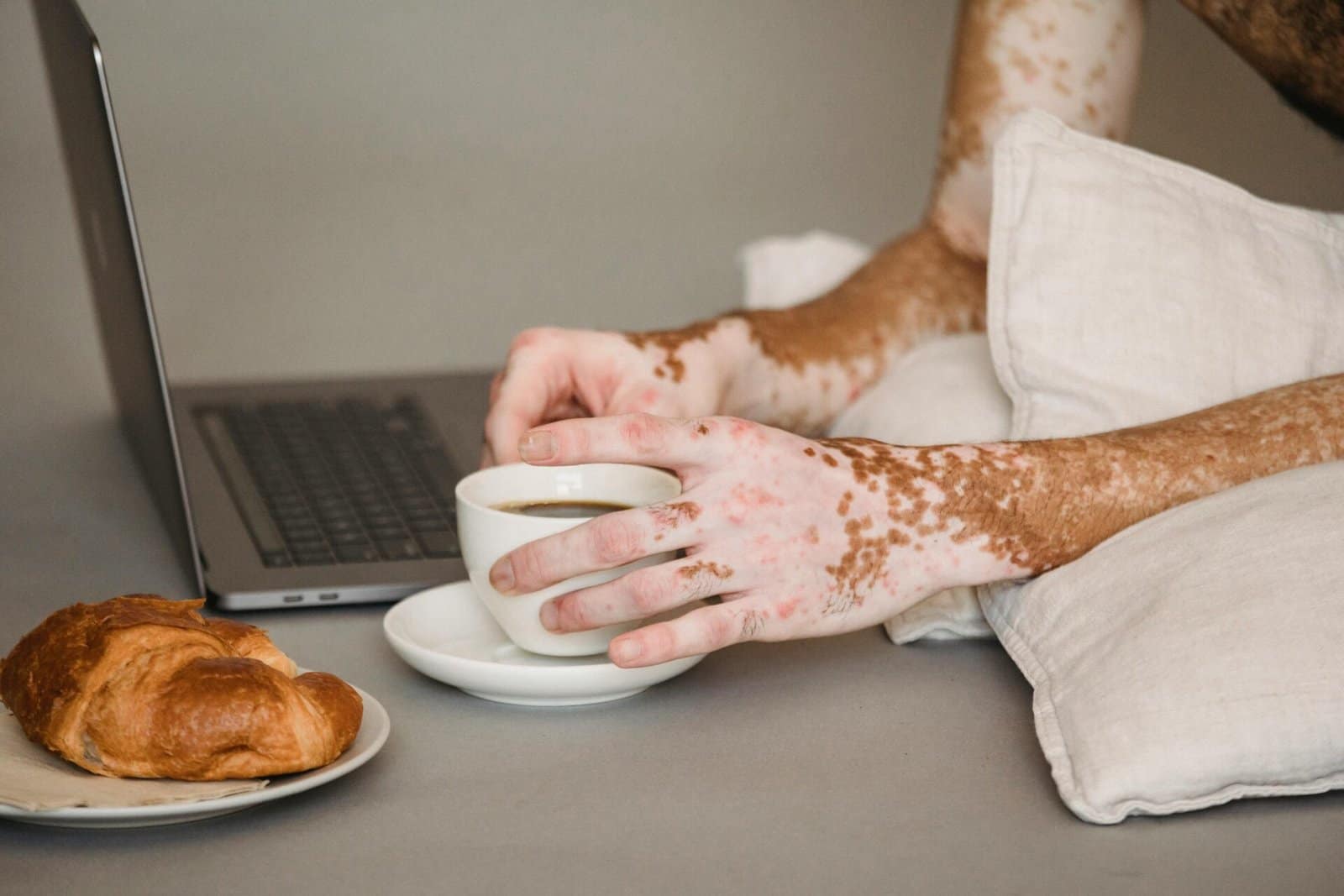 Discover what vitiligo is, its causes, symptoms, treatments, and tips for living with white skin patches confidently and healthily. Vitiligo: Best Skin Care, Causes & Treatment Guide